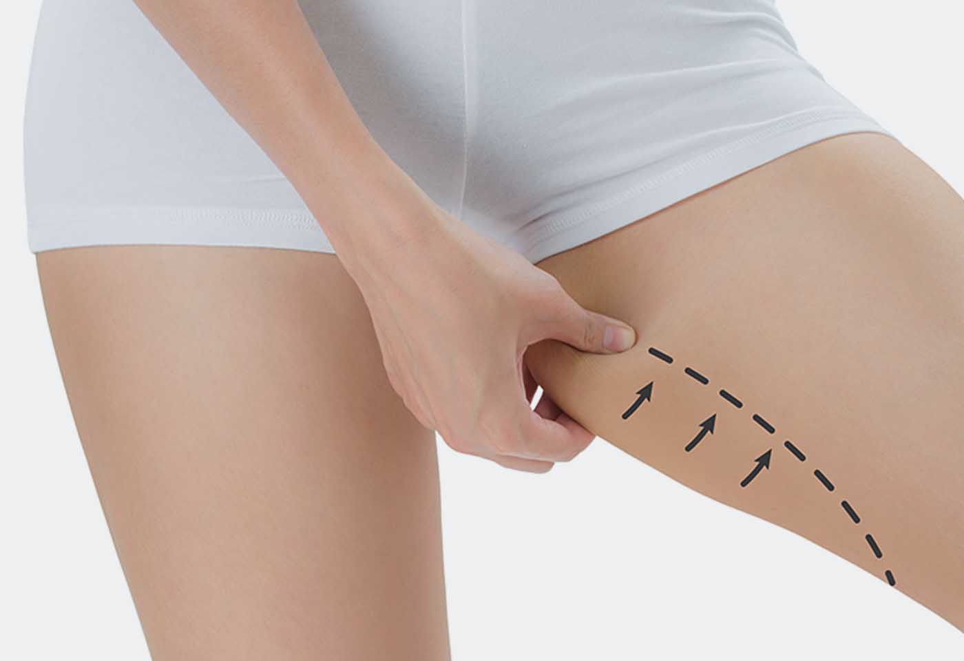 chirurgie esthetique cuisses metz