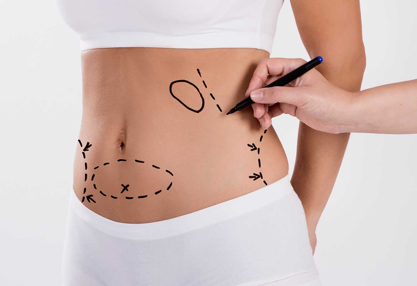 chirurgie esthetique lipoaspiration metz