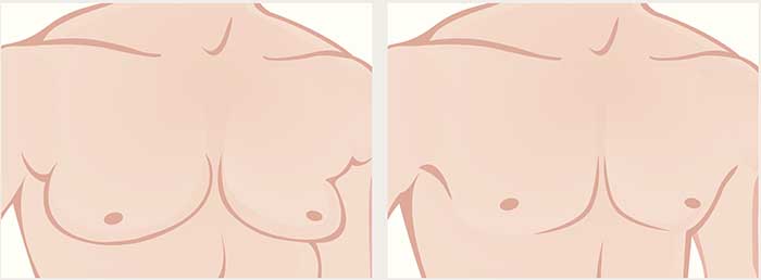 gynecomastie avant après