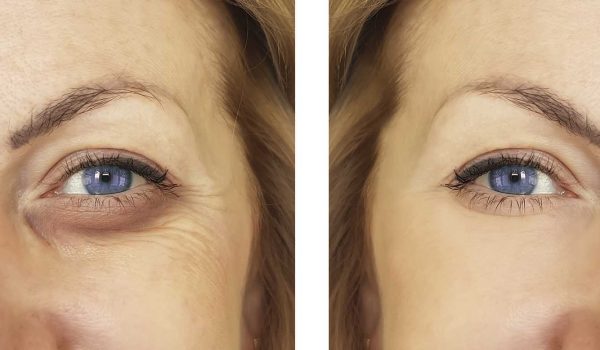 Blépharoplastie féminine