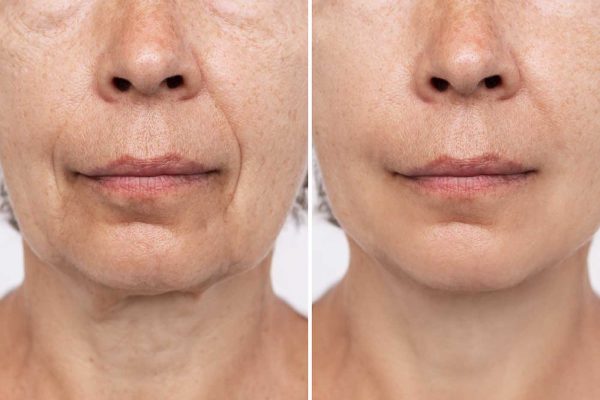 Lifting cervico facial
