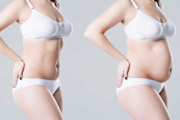 abdominoplastie