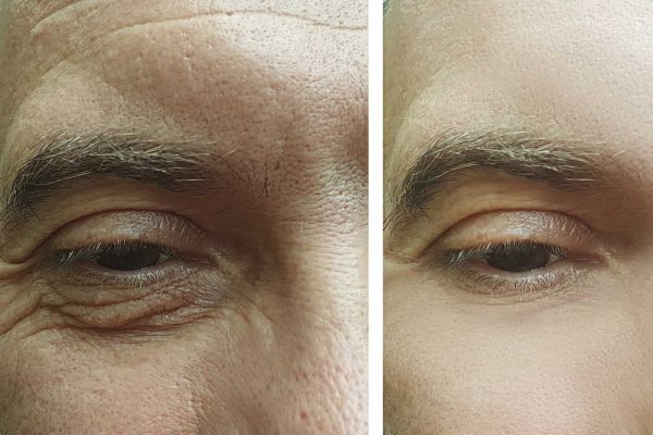 blépharoplastie masculine metz
